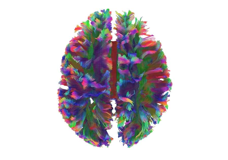 Diffusion MRI reconstructed fiber bundles